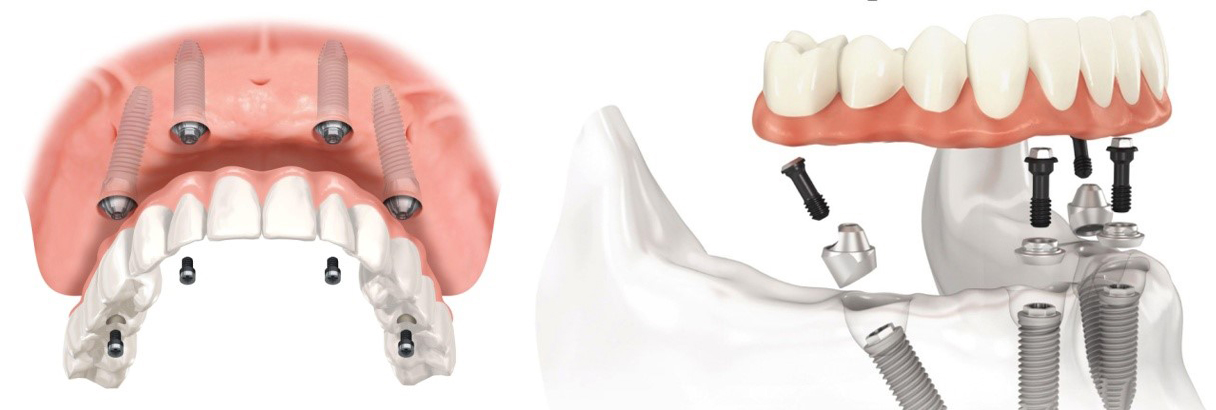 Имплант зуба волгоград. All on 4 имплантация Нобель. Протез на шести имплантах.